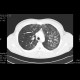 Intraalveolar hemorrhage, case 1: CT - Computed tomography